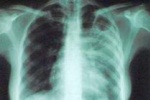 Узбекистан до 2016 года направит $50 млн на борьбу с туберкулезом