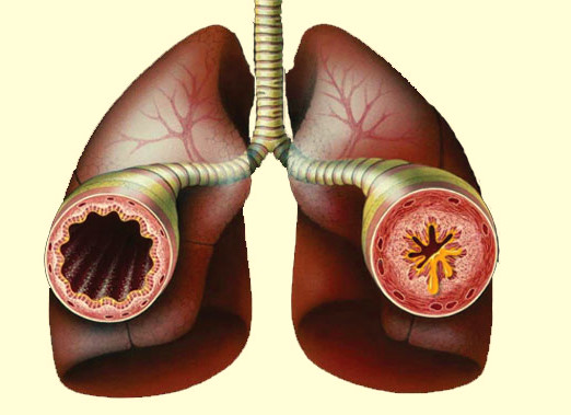 Бронхиал астма
