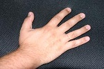 Мужчины с длинным безымянным пальцем больше подвержены раку простаты
