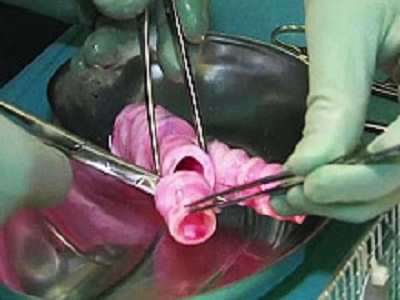 Хирурги впервые в мире пересадили полностью синтетические органы